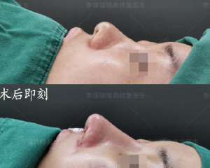 杭州鼻综合修复手术医生预约排名 杭州鼻综合修复手术专家排行榜