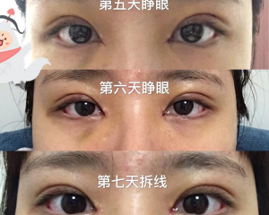 上海九院双眼皮修复最好的专家有哪些？