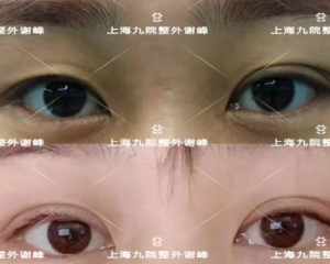 上海九院谁双眼皮修复做得好？上海九院双眼皮修复医生预约排名