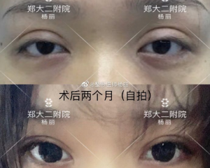 郑州做修复双眼皮好的医生是哪个？杨丽、田国静、孔宇、贾亮、孟明星谁好？