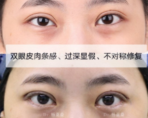 上海哪个医生双眼皮修复比较好？上海眼修复专家预约排名大全