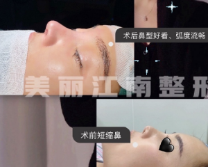 上海美星柴军医生做鼻子怎么样？美星柴军隆鼻技术好吗？