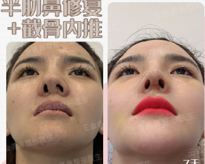 上海鼻修复专家最厉害和权威的是谁？上海隆鼻修复专家预约排行榜大全