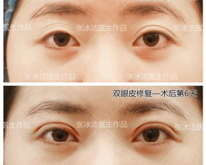 北京张冰洁修复双眼皮怎么样？张冰洁眼修复技术真的好吗？