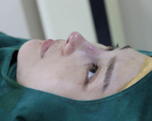 西安张曦和金磊哪个医生鼻综合做的最好?