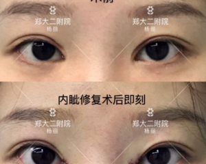郑州双眼皮修复哪个医生比较好？郑州双眼皮修复专家预约排行榜