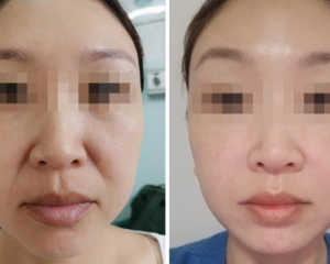 祝东升和李晓东面部提升谁做的好?李晓东祝东升面部提升案例对比在线预约