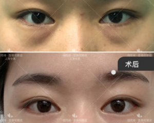 上海双眼皮修复医生哪个最好？杨亚益、沈国雄、朱惠敏、佀同帅、唐毅眼修复谁技术好？