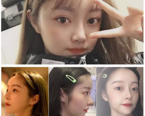 成都黄开亮和邓东伟哪个做鼻子好?邓东伟黄开亮隆鼻案例对比在线预约