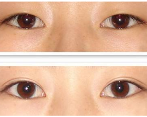 张余光与李志刚哪个做双眼皮最好？李志刚张余光双眼皮技术对比谁更好？