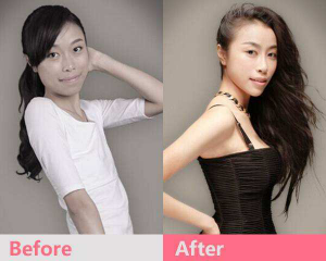 上海九院董佳生和王涛谁隆胸效果好?王涛董佳生隆胸简介案例预约