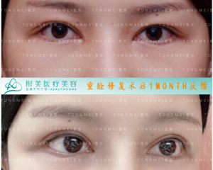 2020年北京眼修复专家排名 2020年北京双眼皮修复医生预约排行榜