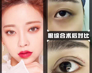 杭州双眼皮医生哪个好？范希玲、石杭燕、王光建、高士乾、姜鑫利哪个医生做双眼皮技术好？