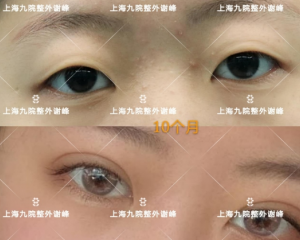 上海九院割双眼皮医生哪个最好？朱海男、顾斌、周慧芳、张余光、朱惠敏、谢峰、苏薇洁怎么样？