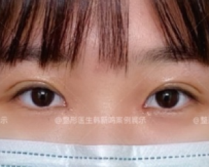 北京最好的整形医院双眼皮医生有哪些？北京最好的整形医院双眼皮专家预约排行榜