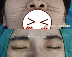 中国哪个医生取鼻子假体最厉害？