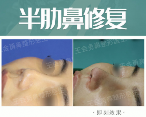 2020年上海鼻修复专家排名 2020年上海隆鼻修复医生预约排行榜