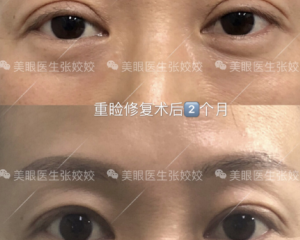 长沙双眼皮修复哪个医院比较好?