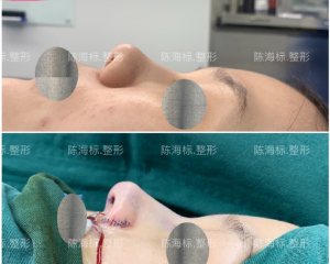 上海陈海标肋骨鼻怎么样？上海陈海标肋骨鼻隆鼻技术好吗？