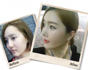 刘彦军和王会勇哪个做鼻修复厉害？王会勇和刘彦军隆鼻修复案例预约对比