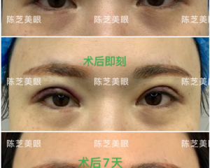深圳做双眼皮修复最好的医生有哪些？深圳修复双眼皮最好的专家排名