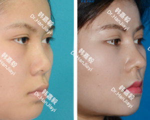 上海哪个医生做鼻子好？上海预约最多知名鼻子专家排名