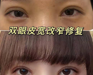 长沙双眼皮修复哪个医生做的比较好？解灿、张姣姣、刘磊、田芳斌、罗亮眼修复怎么样？
