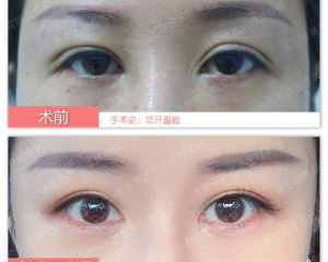 南京双眼皮修复哪个医生最好？刘育凤、王金明、‍陈小剑、周长兵、李志生谁修复双眼皮技术更好？