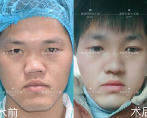 上海做畸形鼻修复的医生哪个好？上海做畸形鼻修复专家预约排行榜