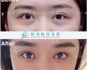北京修复双眼皮专家是谁？北京眼修复医生预约排名