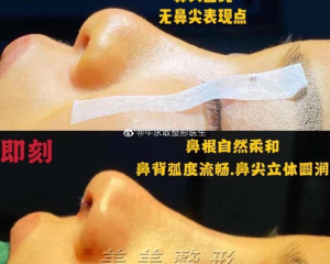 郑州最出名的鼻整形医生是哪个？郑州最出名的鼻整形专家预约排名大全
