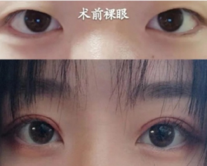 靳小雷和于晓波哪个做眼睛技术好？靳小雷和于晓波双眼皮技术谁更好？