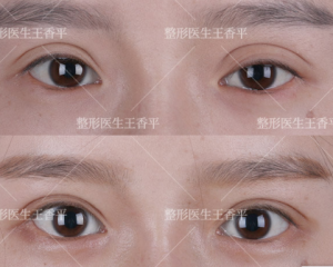 王香平做双眼皮和双眼皮修复怎么样？王香平眼修复技术简介预约