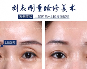 大连刘志刚高难度双眼皮修复案例 刘志刚修复双眼皮案例在线预约
