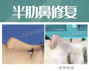 上海技术最好的鼻修复专家是谁？上海隆鼻修复预约排名大全