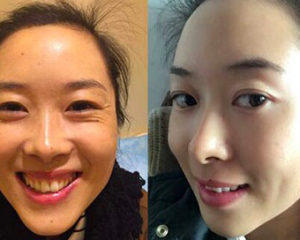 北京面部提升杨大平和祝东升哪个整形好?祝东升杨大平面部提升案例对比在线预约