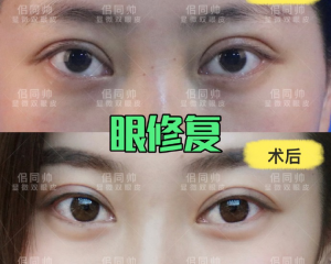 上海哪个医生双眼皮修复技术好？上海眼修复预约最多的医生排行榜
