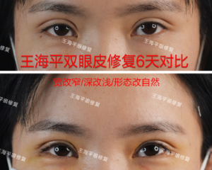 武汉做双眼皮修复最好的医生有哪些？武汉修复双眼皮医生预约排行榜