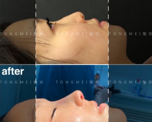 李长赋做鼻综合价格大概多少？李长赋鼻综合简介预约案例