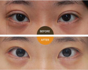 北京双眼皮修复比较好的医生有哪些？北京眼修复预约最多的专家排名