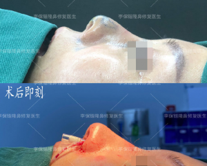 杭州修复鼻子最好的医生是哪个？杭州修复鼻子最好专家预约排名大全