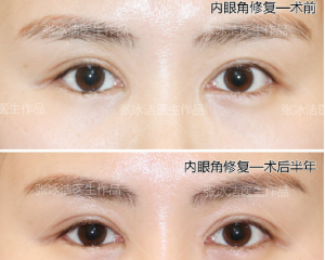 北京做双眼皮修复哪些医生厉害？北京双眼皮修复医生预约排行榜