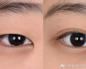 上海华美医院割双眼皮哪个医生最好？杨亚益和佀同帅做眼睛谁更厉害？