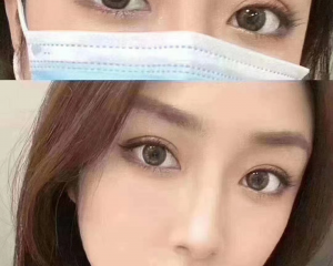 郑州哪个医生做双眼皮手术最好？郑州双眼皮最好的医生预约排名