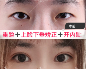 上海做双眼皮厉害的医生排名 上海做双眼皮厉害的专家排行榜