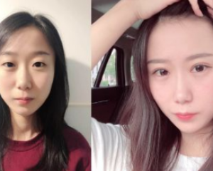 上海哪个医生割双眼皮好？苏薇洁、周兆平、杨亚益、朱迪、徐晓斐哪个做双眼皮技术口碑反馈好？