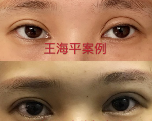 武汉专门修复双眼皮专家哪个最好？