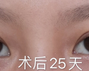 西安最好的双眼皮医生排名最新推荐:杨益、韩俊祥、罗金刚、孙峰、舒茂国技术怎么样？