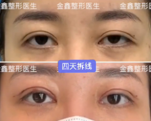 深圳有哪些做双眼皮修复的医生有哪些？深圳眼修复专家预约排行榜