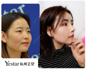 杭州最好的鼻子修复专家是谁？杭州最好的鼻子修复医生谁最厉害？